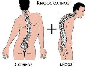 Нарушение на развитието на гръбначния стълб: кифосколиоза