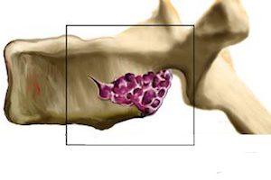 Хемангиом на гръбначния стълб: ефективни методи на лечение