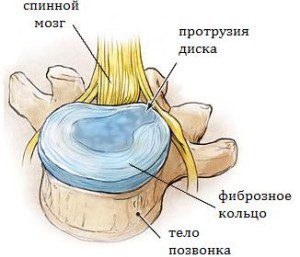 Как да откриете и лекувате издатината на гръбначния диск