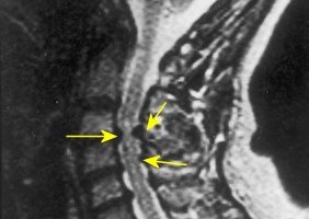 Как да разпознаем и лекуваме миелопатията на цервикалната, гръдната и лумбалната част на гръбначния стълб?