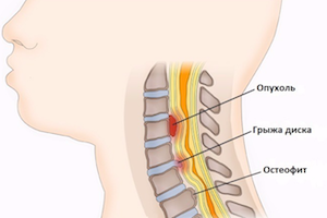 Как да разпознаем и лекуваме миелопатията на цервикалната, гръдната и лумбалната част на гръбначния стълб?