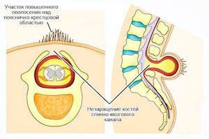 Неразширяване на гръбначните арки: признаци на произход, етапи и методи на лечение