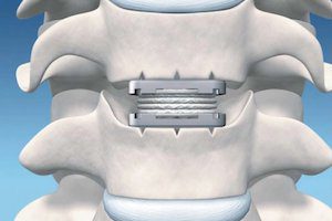 Операции на гръбнака: дисков имплант