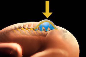 Разделяне на гръбнака: кога и как може да бъде коригирана