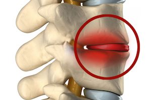 Spondylodiscitis на гръбначния стълб: причини, симптоми на заболяването и начини на лечение