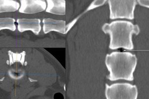 Вакуумен феномен на гръбначните дискове: методи за тяхното откриване и лечение