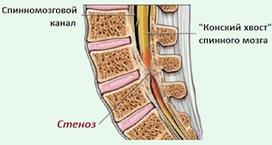 Стенозата на гръбначния канал е опасно