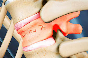 Фрактура на гръбначния стълб (консолидиран): prevent difficult, cure - possible