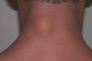 Липома на гръбнака: характеристики на образуването и методи на елиминиране