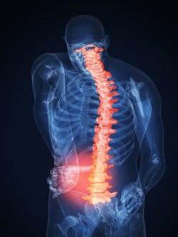 Какво представлява гръбначната стеноза, нейните причини, степени, симптоми, лечение