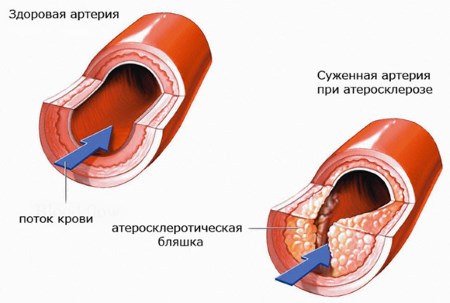 Каква е стенозата на вертебралната артерия, нейните причини, симптоми, диагноза и лечение