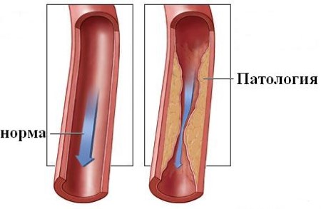 Каква е стенозата на вертебралната артерия, нейните причини, симптоми, диагноза и лечение