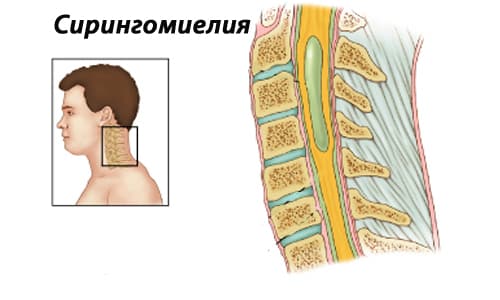 Причини, симптоми и методи за лечение на гръбначния мозък (ICD-10 - код G 95.0)