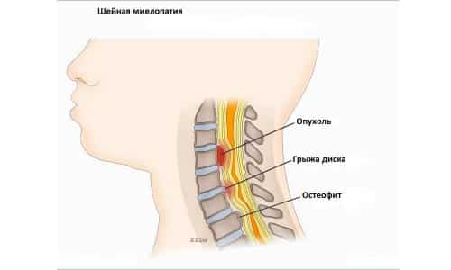 Симптомите и лечението на компресионната миелопатия на шийката на гръбначния стълб