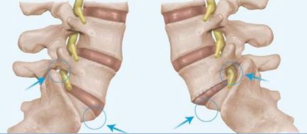 Симптомите и лечението на спондиолист на гръбначния стълб на гръбначния стълб