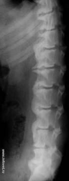 Симптоми и лечение на спондилоза на лумбалния гръбначен стълб