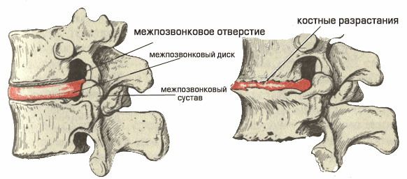 Симптоми и лечение на спондилоза на лумбалния гръбначен стълб