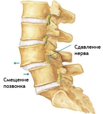 Симптомите и лечението на прешлените на прешлените на цервикалната и лумбалната част на гръбначния стълб