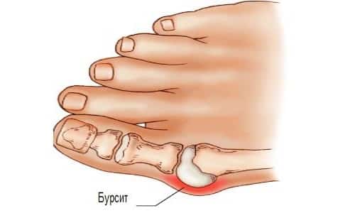 Причини, симптоми и методи за лечение на бурсит на големия пръст
