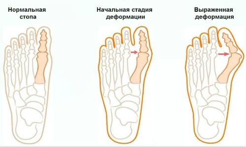 Причини, симптоми и методи за лечение на артроза на големия пръст