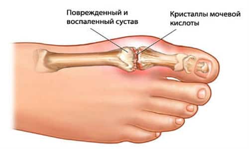 Причини, симптоми и методи за лечение на артроза на големия пръст