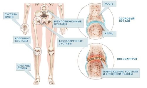 Ревматоиден артрит – причини, симптоми, лечение
