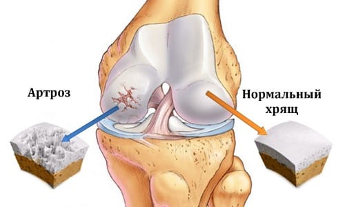 Степени, симптоми, лечение и профилактика на артрозата на колянната става