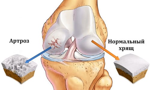 Как да изберем правилното ортопедично коляно, когато артрозата на колянната става?