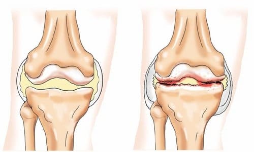 Методи за лечение на артрит на костно коляно