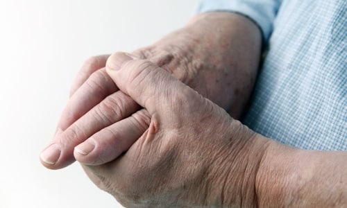 Ревматоиден артрит: симптоми, диагноза, диагностични критерии, лечение