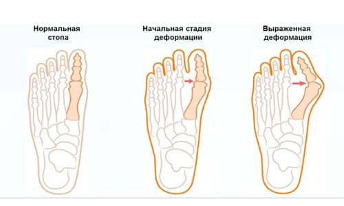 Симптоми и лечение на бурсит на краката и глезена