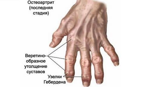 Симптоми и лечение на деформиране на артроза на малки стави на ръцете