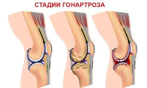 Симптоми, диагноза и лечение на ганартроза на колянната става 1,2,3 градуса