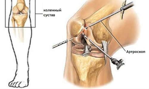 Симптоми, диагноза и лечение на ганартроза на колянната става 1,2,3 градуса