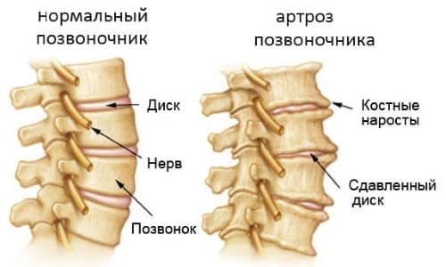 Симптоми, диагностика, лечение и гимнастика за артроза на гръбначния стълб