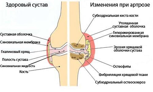 Използването на магнитотерапия при лечение на артроза на колянната става