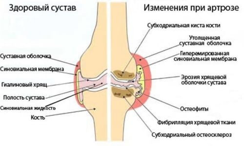 Лечение на артроза на колянната става 1,2,3 градуса: лекарства, физиотерапия и други методи