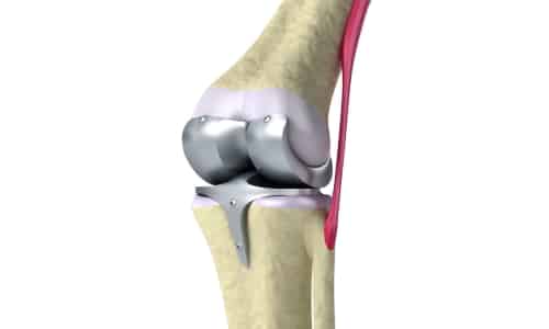 Лечение на артроза на колянната става 1,2,3 градуса: лекарства, физиотерапия и други методи