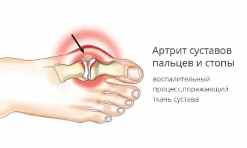 Защо наранява болката на пръстите: причините, симптомите, лечението