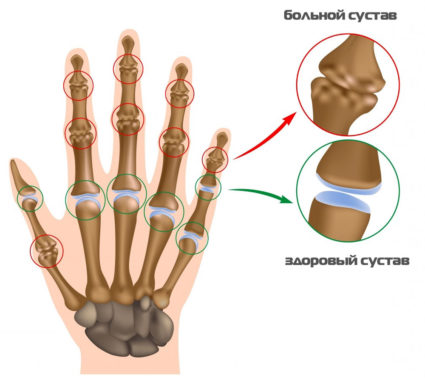 Причините и симптомите на болезненост в пръстите