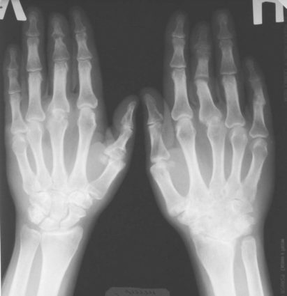 Причините и симптомите на болезненост в пръстите