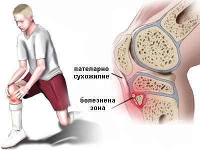 Причини за болки в коляното при огъване