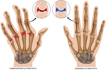 Ако наранявате ставите на пръстите или краката, разберете причината за болката, лекувайте ставите