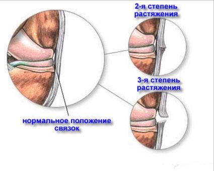 Увреждания на сухожилията на колянната става: причини, симптоми, последици