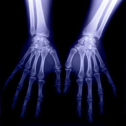 Симптоми на полиартрит на пръстите и ръцете и методи на лечение