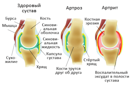 Разлики в артрита от артроза - физиологични процеси