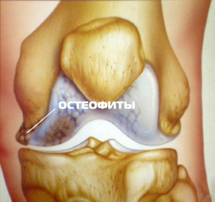 Как да се отървем от остеофитите в колянната става?