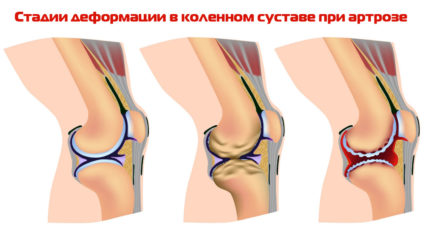 Как да се отървем от остеофитите в колянната става?