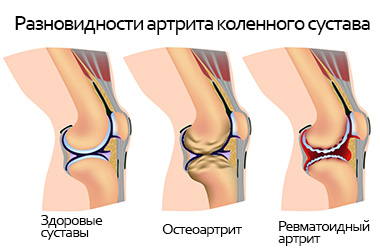 Какво може да причини болка в колянната става