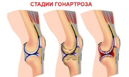 Какво може да причини болка в колянната става